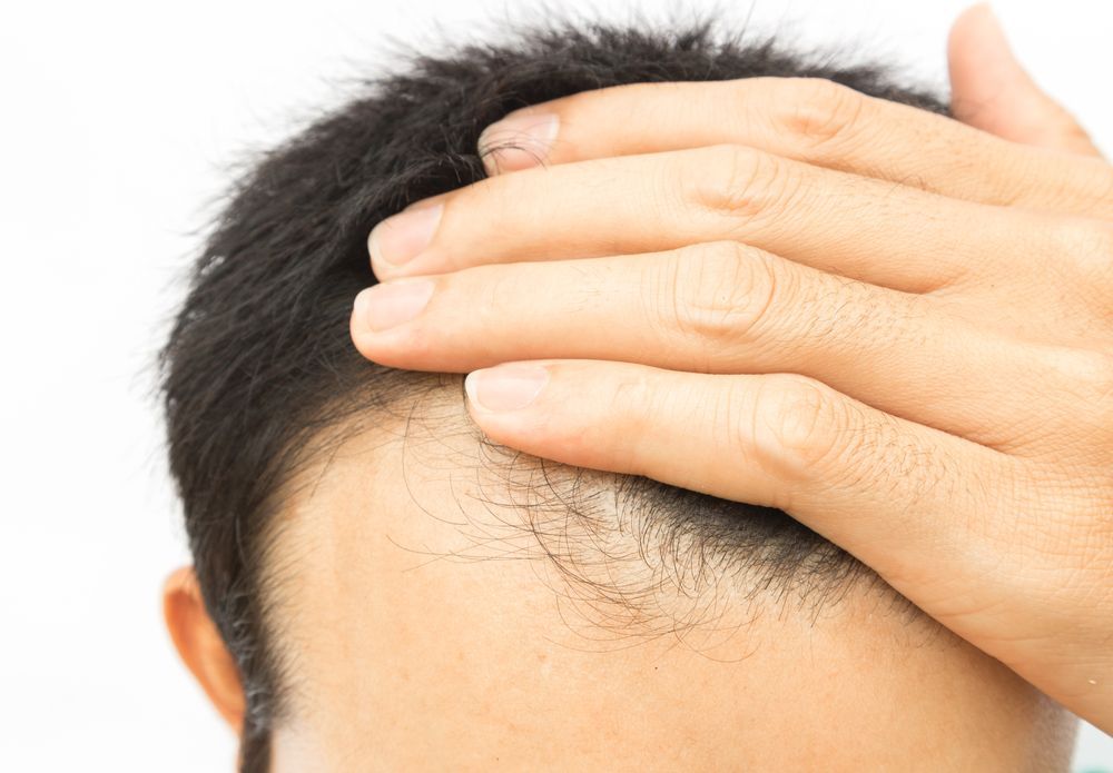 Alopecia masculina