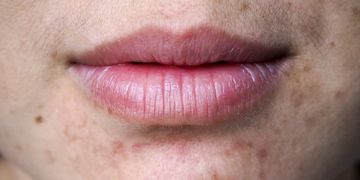 Cicatrices y manchas post-acné: ¿Cómo eliminarlas?