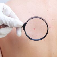 ¿Son peligrosos los angiomas? Todo lo que nunca te han contado sobre los angiomas