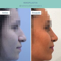 Rinoplastia - Clínica FEMM