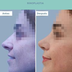 Rinoplastia - Clínica FEMM