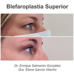 Blefaroplastia - Dra Elena Garcia Vilariño