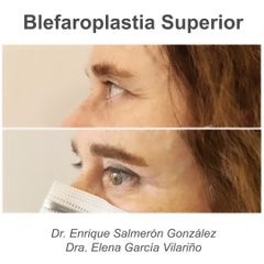 Blefaroplastia - Dra Elena Garcia Vilariño
