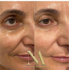 Eliminación de ojeras - Clínica Loveliness