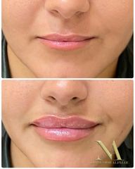 Aumento de labios - Clínica Loveliness