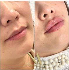 Aumento de labios - Clínica Loveliness