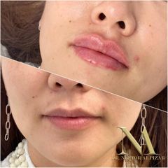 Aumento de labios - Clínica Loveliness