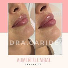 Aumento de labios - Dr. Caride - Clínica Came