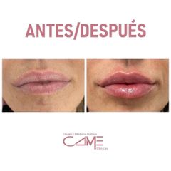 Aumento de labios - Clínicas Came