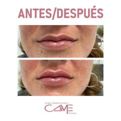 Aumento de labios - Clínicas Came