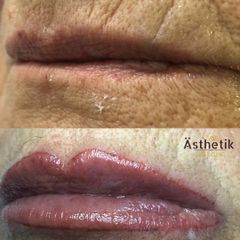 Aumento de labios - Dentalias