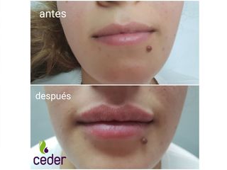Antes y después Aumento de labios