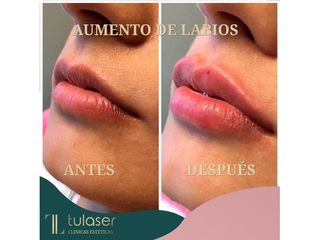 Antes y después Aumento de labios