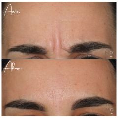 Rellenos faciales - Clínica Graziella Moraes
