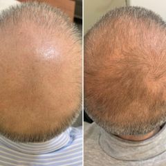 Trasplante capilar - Clinica Adcure