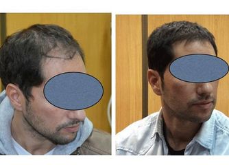 Antes y después microinjertos 