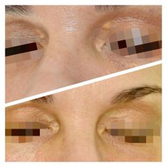 Xantelasmas - Clínica De Medicina Estética Córdoba