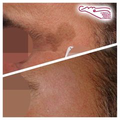 Tratamiento antimanchas - Clínica De Medicina Estética Córdoba