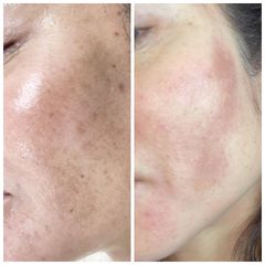 Tratamiento con láser para eliminar las manchas - Marista Clínica