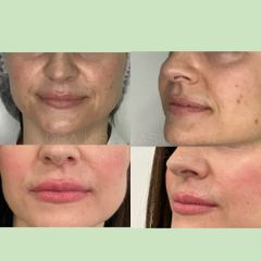 Aumento de Labio e Hidratacion - Monalisa Clínicas