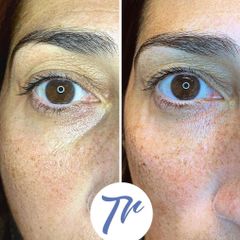 Eliminación de ojeras - Dr. José María Triviño Fernández