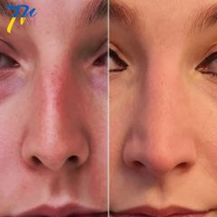 Rinoplastia - Dr. José María Triviño Fernández