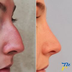 Rinoplastia - Dr. José María Triviño Fernández