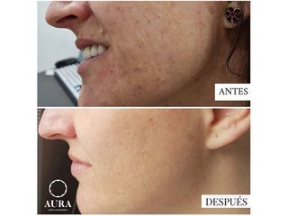 Antes y después Tratamiento antimanchas