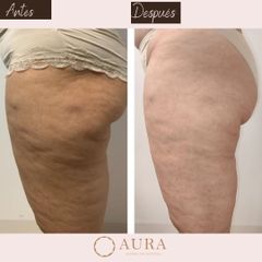 Mesoterapia - Aura Clínica