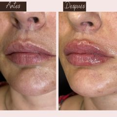 Aumento de labios - Aura Norte
