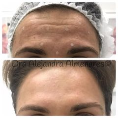 Bótox - Dra. Alejandra Almenares
