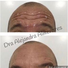 Bótox - Dra. Alejandra Almenares