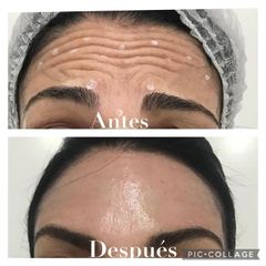 Bótox - Dra. Alejandra Almenares