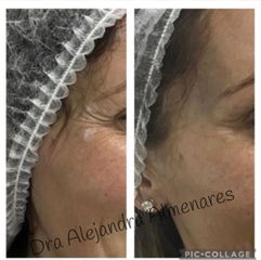 Bótox - Dra. Alejandra Almenares