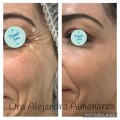 Bótox - Dra. Alejandra Almenares