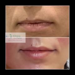 Aumento de labios - Clínica Fama