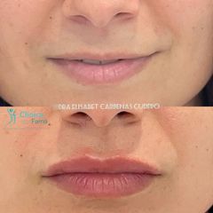 Aumento de labios - Clínica Fama