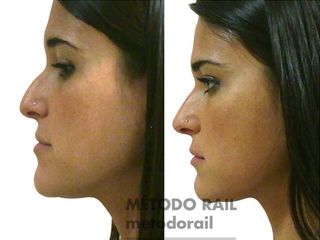 Antes y después Rinoplastia