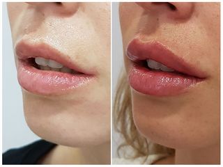 aumento labios