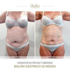Balón gástrico - Ilahy Instituto Dermoestético