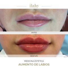 Aumento de labios - Ilahy Instituto Dermoestético