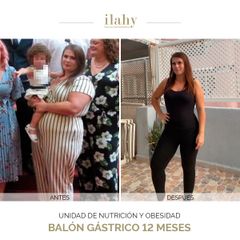 Balón gástrico 12 meses - Pérdida de 37 kilos - Ilahy Instituto Dermoestético