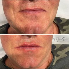Aumento de labios - Clínica Díaz Caparrós