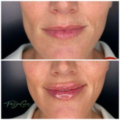 Aumento de labios - Clínica Díaz Caparrós