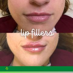 Aumento de labios - Clínica Díaz Caparrós