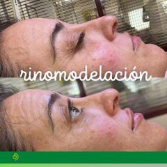 Rinomodelación  - Clínica Díaz Caparrós