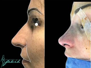 Rinoplastia - Dr. Ibrahim Fakih