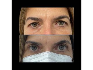 Blefaroplastia - Dr. Ibrahim Fakih
