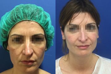 Antes y después Rinoplastia 