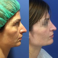 Antes y después Rinoplastia